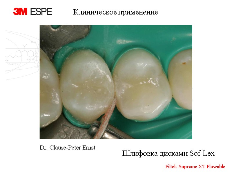 Шлифовка дисками Sof-Lex Клиническое применение